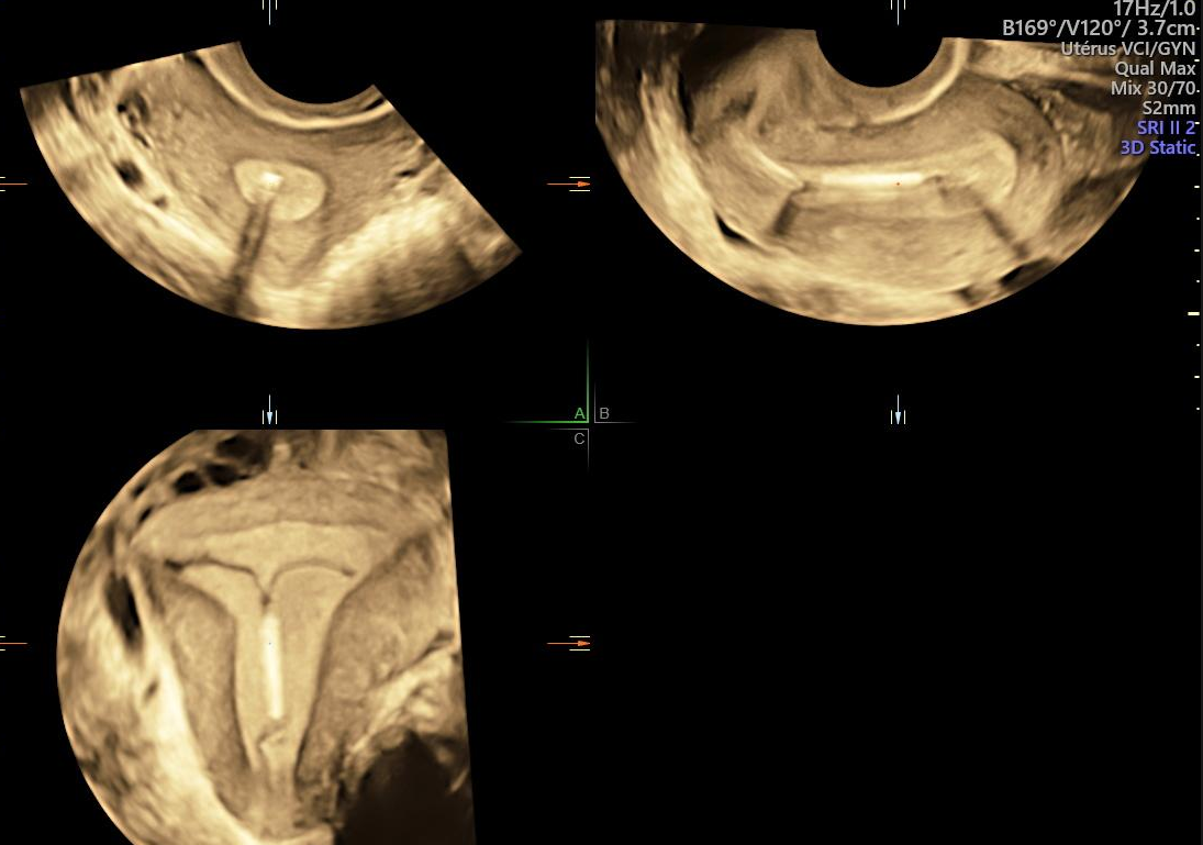Échographie Pelvienne de contrôle de dispositifs intra utérins (stérilets) Céline Foinant