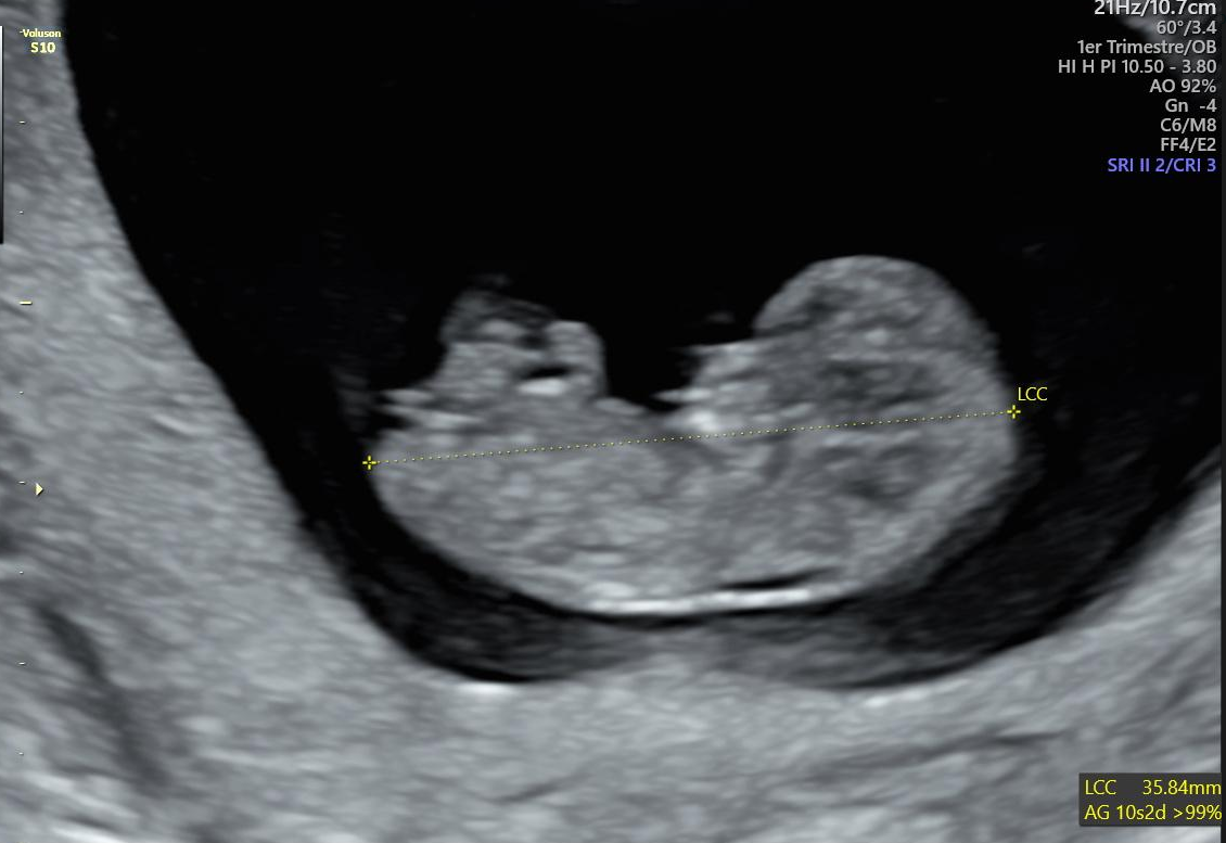 Échographie dite précoce ou échographie de datation Céline Foinant