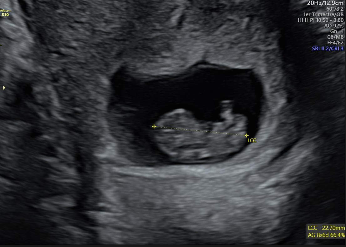 Échographie dite précoce ou échographie de datation Céline Foinant