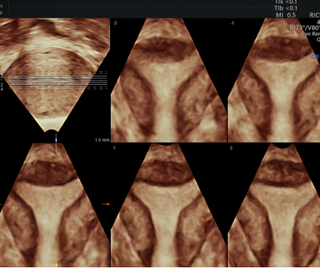 Echographie pelvienne dans le cadre de la PMA